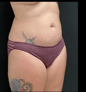 Liposuction Female Before & After Patient #15971