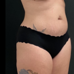 Liposuction Female Before & After Patient #15971