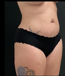 Liposuction Female Before & After Patient #15971