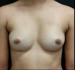 Nipple Reduction Before & After Patient #16004