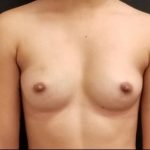 Nipple Reduction Before & After Patient #16004
