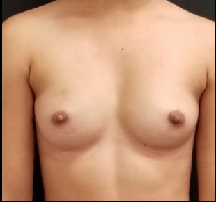 Nipple Reduction Before & After Patient #16004
