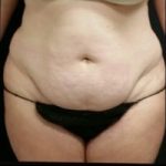 Abdominoplasty Before & After Patient #15904