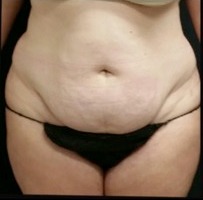 Abdominoplasty Before & After Patient #15904