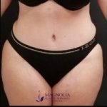 Abdominoplasty Before & After Patient #15904