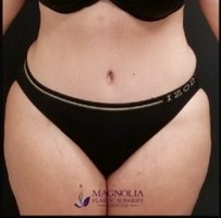Abdominoplasty Before & After Patient #15904