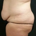 Abdominoplasty Before & After Patient #15904