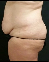 Abdominoplasty Before & After Patient #15904