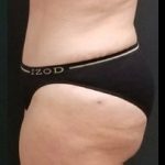 Abdominoplasty Before & After Patient #15904