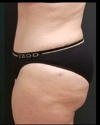 Abdominoplasty Before & After Patient #15904