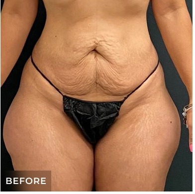 Abdominoplasty Before & After Patient #15913
