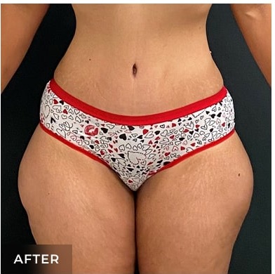 Abdominoplasty Before & After Patient #15913