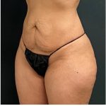 Abdominoplasty Before & After Patient #15913
