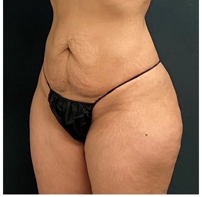 Abdominoplasty Before & After Patient #15913