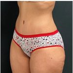 Abdominoplasty Before & After Patient #15913