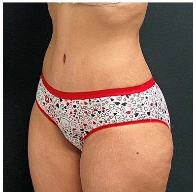 Abdominoplasty Before & After Patient #15913