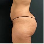 Abdominoplasty Before & After Patient #15913