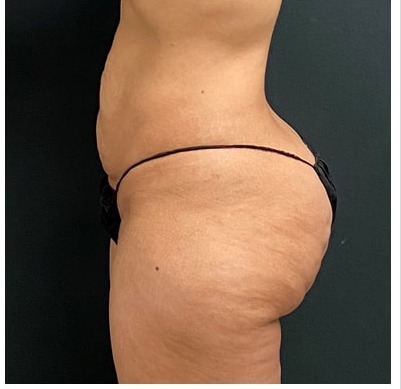 Abdominoplasty Before & After Patient #15913