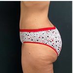 Abdominoplasty Before & After Patient #15913