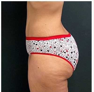 Abdominoplasty Before & After Patient #15913