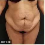Abdominoplasty Before & After Patient #15914