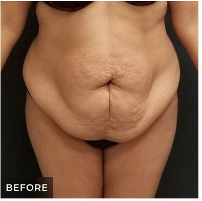 Abdominoplasty Before & After Patient #15914