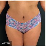 Abdominoplasty Before & After Patient #15914