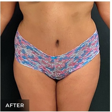 Abdominoplasty Before & After Patient #15914