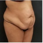 Abdominoplasty Before & After Patient #15914