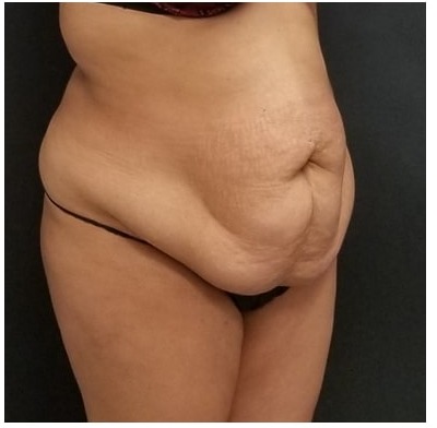 Abdominoplasty Before & After Patient #15914