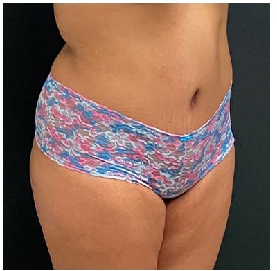 Abdominoplasty Before & After Patient #15914