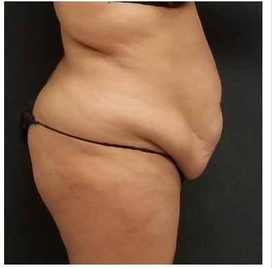 Abdominoplasty Before & After Patient #15914