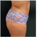 Abdominoplasty Before & After Patient #15914
