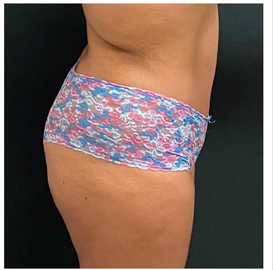 Abdominoplasty Before & After Patient #15914