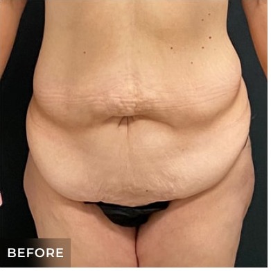 Abdominoplasty Before & After Patient #15915
