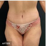Abdominoplasty Before & After Patient #15915