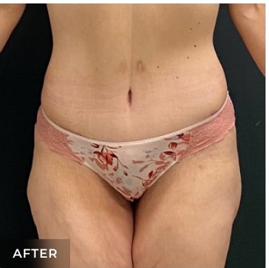 Abdominoplasty Before & After Patient #15915
