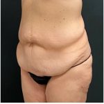 Abdominoplasty Before & After Patient #15915