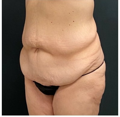 Abdominoplasty Before & After Patient #15915