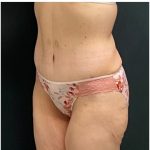 Abdominoplasty Before & After Patient #15915