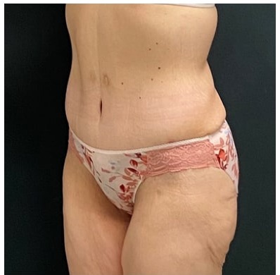 Abdominoplasty Before & After Patient #15915