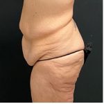 Abdominoplasty Before & After Patient #15915