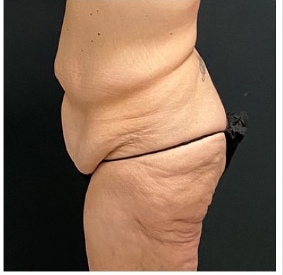 Abdominoplasty Before & After Patient #15915