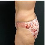 Abdominoplasty Before & After Patient #15915