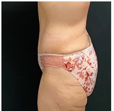 Abdominoplasty Before & After Patient #15915