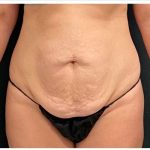 Abdominoplasty Before & After Patient #15916