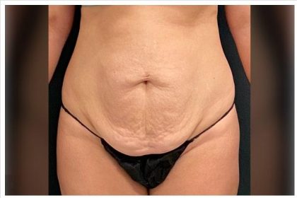 Abdominoplasty Before & After Patient #15916