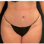 Abdominoplasty Before & After Patient #15916
