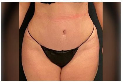 Abdominoplasty Before & After Patient #15916