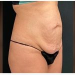 Abdominoplasty Before & After Patient #15916